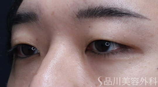 症例NO.71507のBEFORE写真