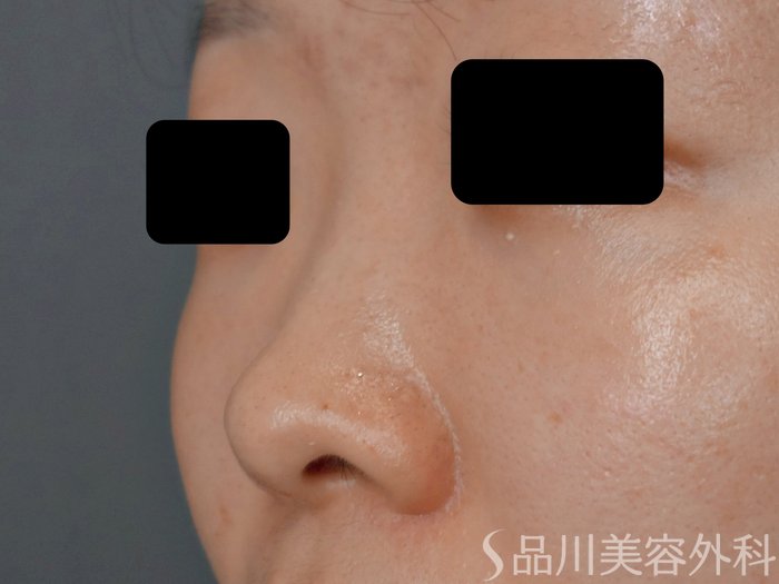 症例NO.71882のBEFORE写真