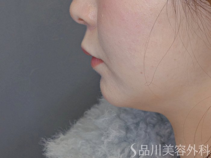 症例NO.72406のBEFORE写真