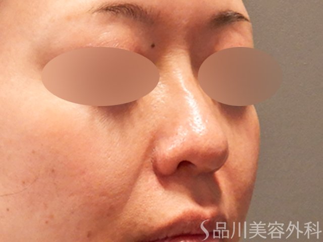 症例NO.69576のAFTER写真