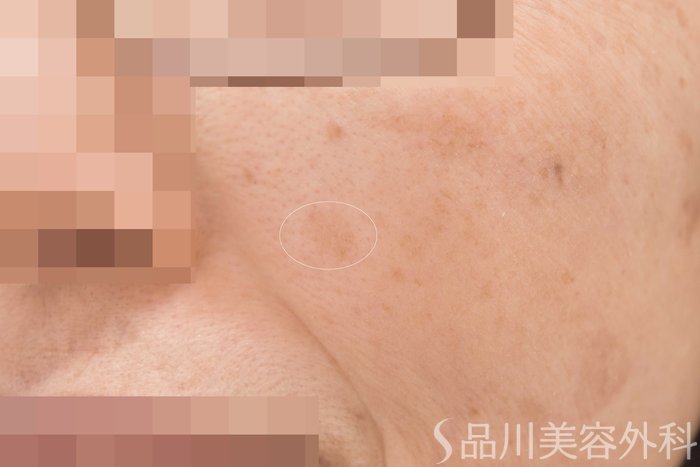 症例NO.64778のBEFORE写真