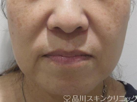 症例NO.36119のBEFORE写真