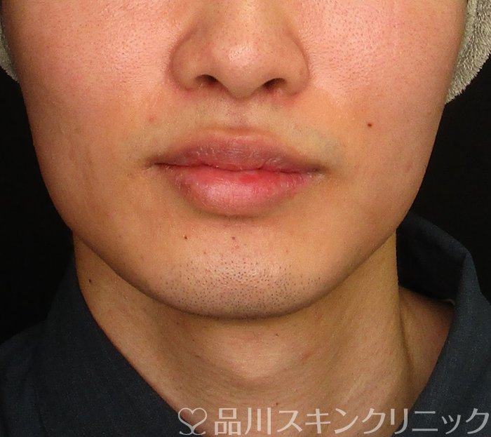症例NO.70339のBEFORE写真
