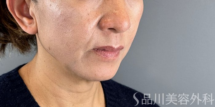 症例NO.72475のBEFORE写真