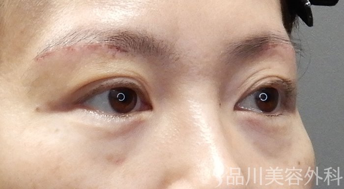 症例NO.70688のAFTER写真