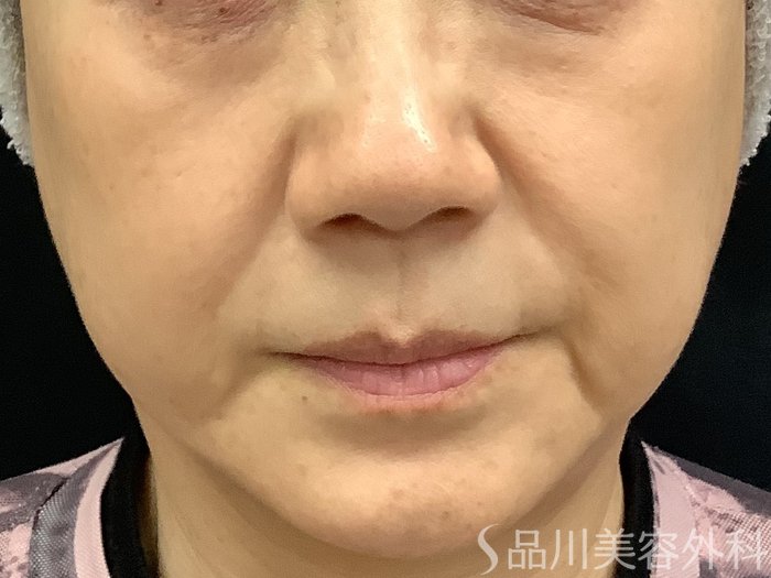 症例NO.67772のBEFORE写真