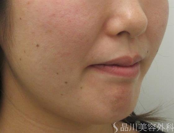 症例NO.20223のBEFORE写真