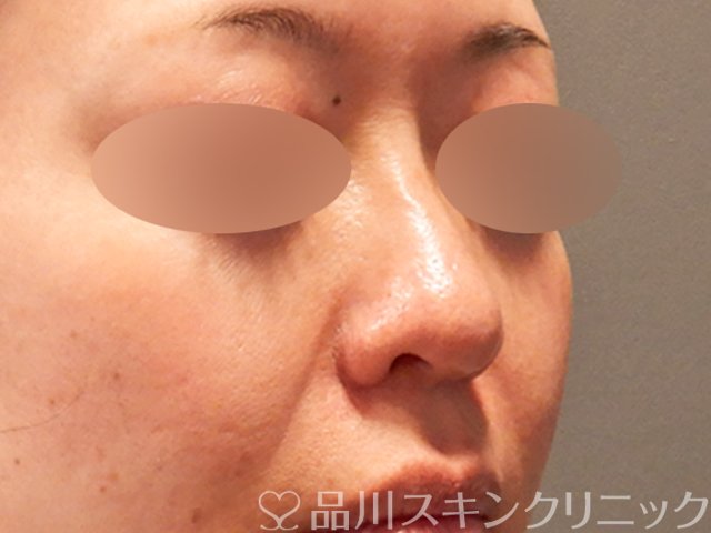 症例NO.69576のAFTER写真