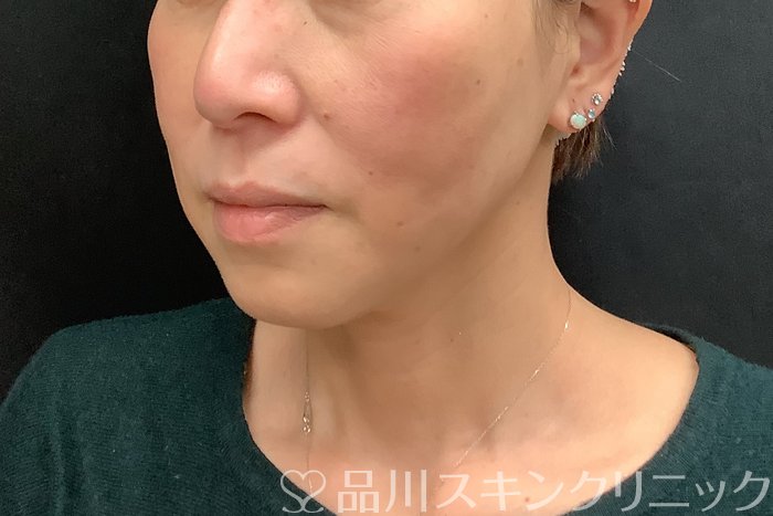 症例NO.71293のAFTER写真