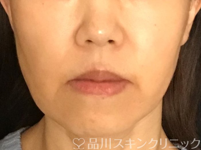 症例NO.65491のBEFORE写真