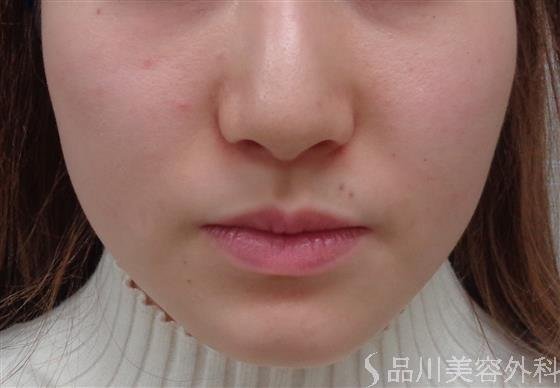 症例NO.47042のBEFORE写真