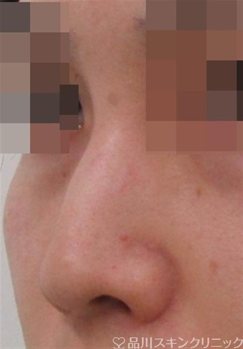 症例NO.39009のBEFORE写真