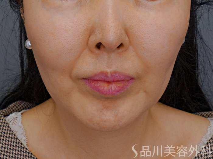 症例NO.74089のBEFORE写真