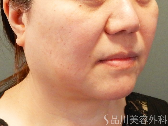 症例NO.64753のBEFORE写真
