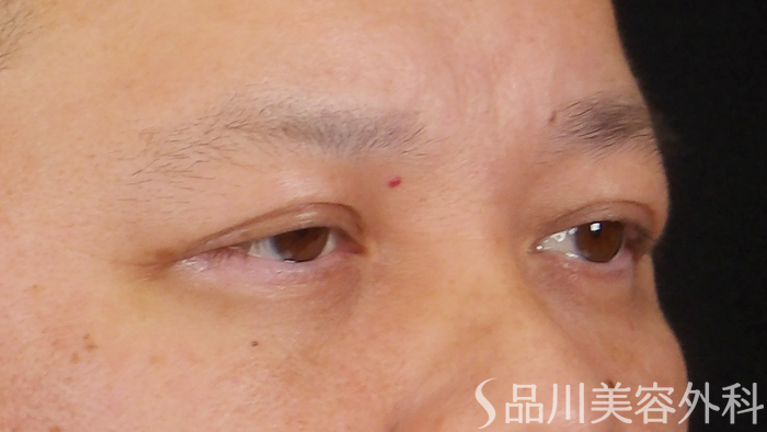 症例NO.70527のAFTER写真