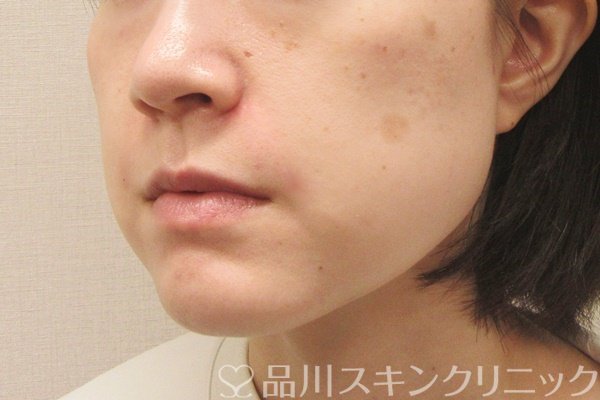 症例NO.69276のAFTER写真
