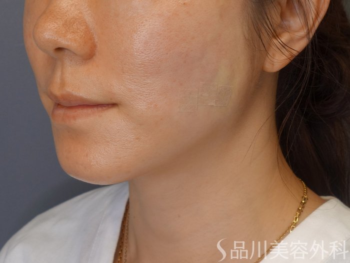 症例NO.72078のAFTER写真