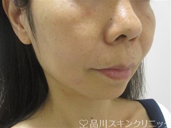 症例NO.38242のAFTER写真