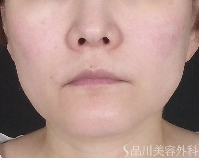 症例NO.65619のBEFORE写真