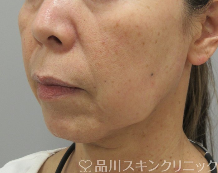 症例NO.74894のBEFORE写真