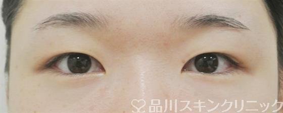 症例NO.43267のBEFORE写真