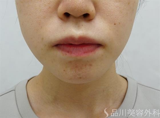 症例NO.51373のBEFORE写真