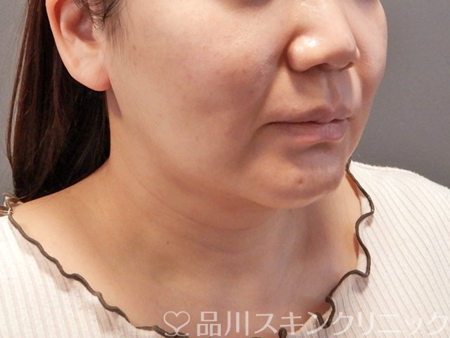 症例NO.69214のAFTER写真