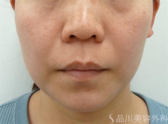 症例NO.46681のBEFORE写真