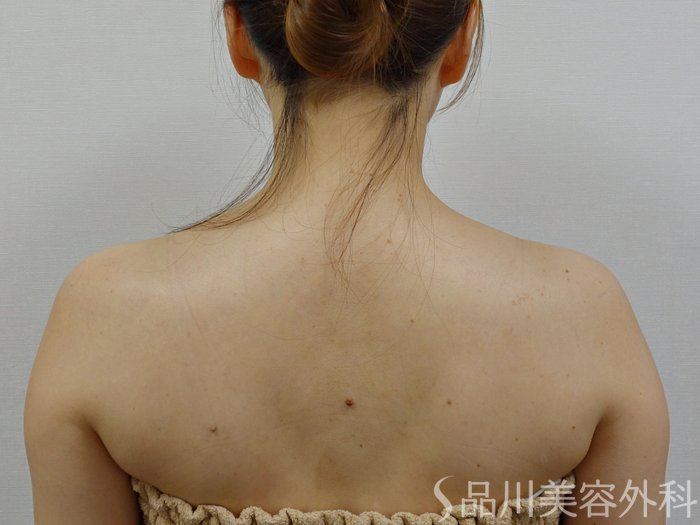 症例NO.74352のBEFORE写真
