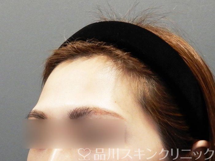 症例NO.73207のBEFORE写真