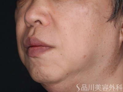 症例NO.70772のBEFORE写真
