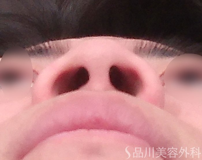 症例NO.69162のBEFORE写真