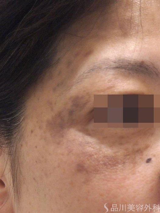 症例NO.22909のBEFORE写真