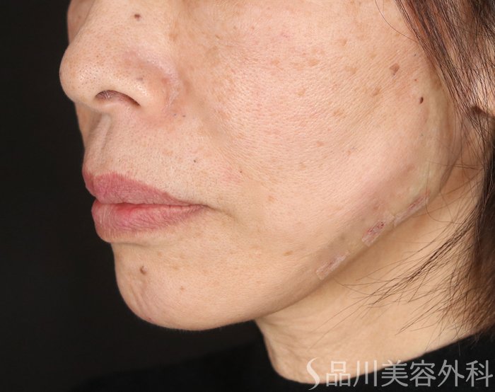 症例NO.72936のAFTER写真