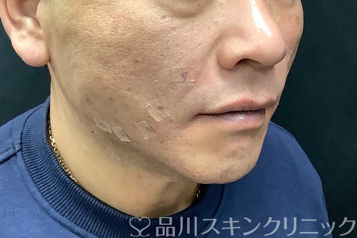 症例NO.69615のAFTER写真