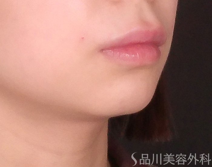 症例NO.70561のBEFORE写真