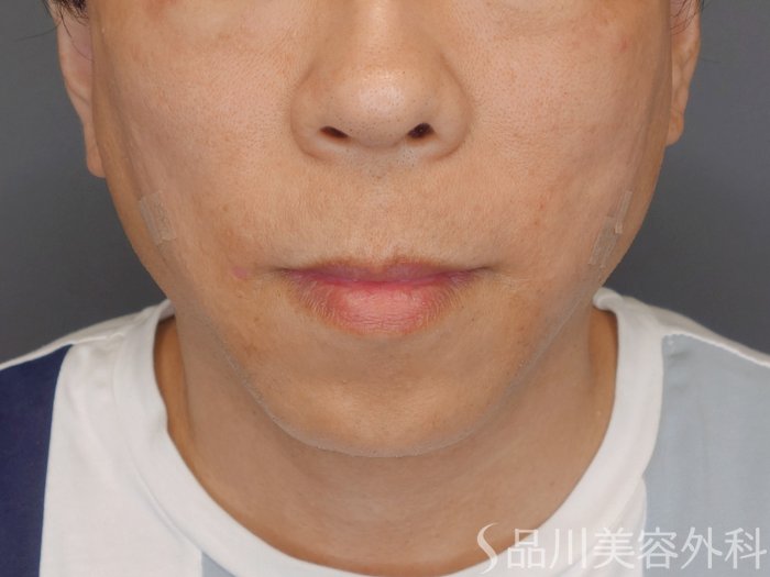 症例NO.72071のAFTER写真