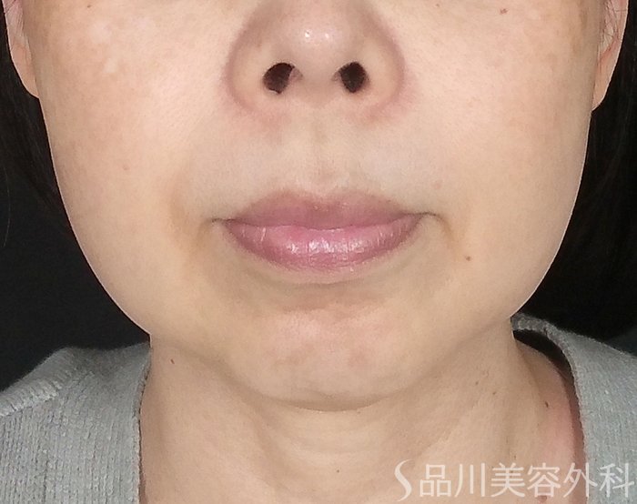 症例NO.64809のBEFORE写真