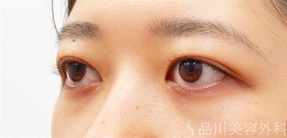 症例NO.51161のAFTER写真