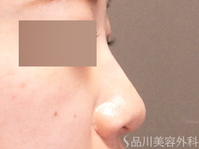 症例NO.70723のAFTER写真