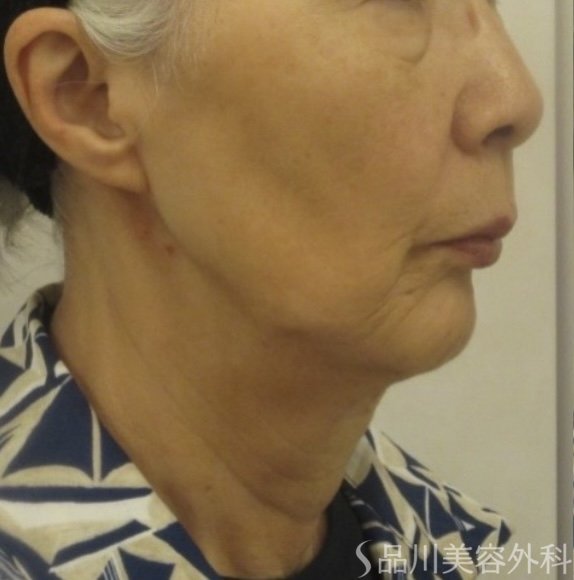 症例NO.74937のBEFORE写真