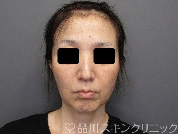 症例NO.74934のBEFORE写真