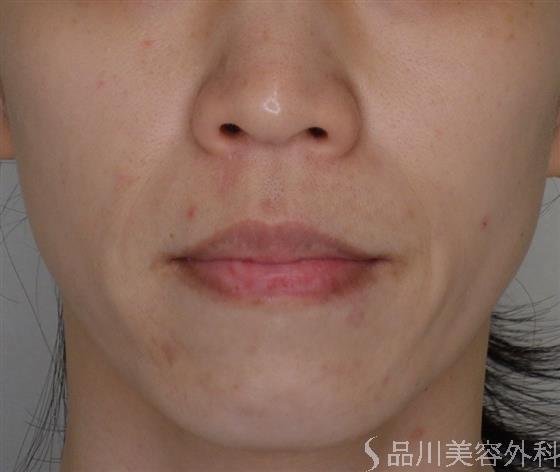 症例NO.50060のBEFORE写真