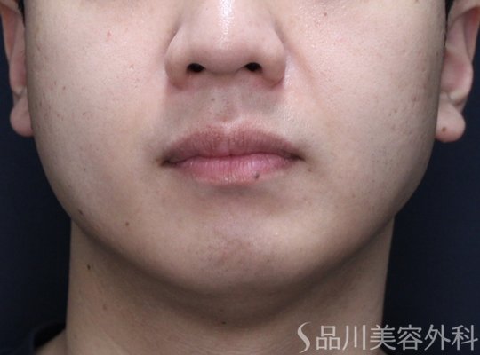 症例NO.72147のAFTER写真