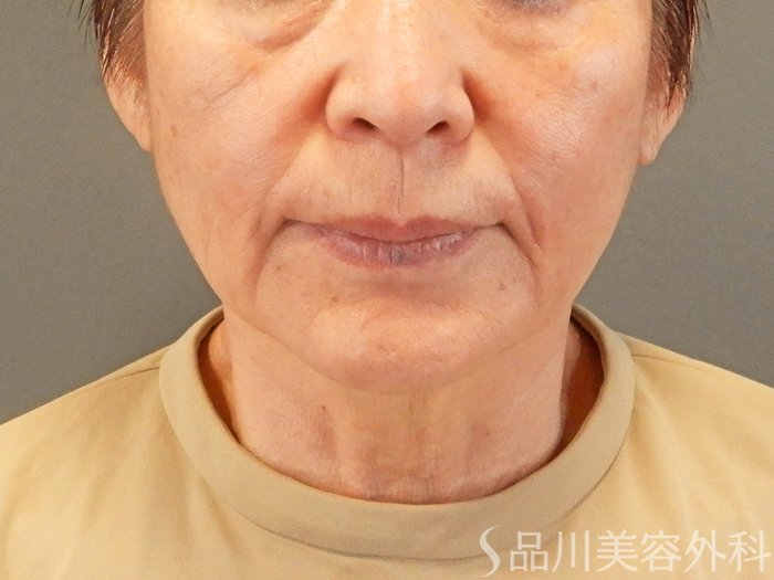 症例NO.65616のAFTER写真