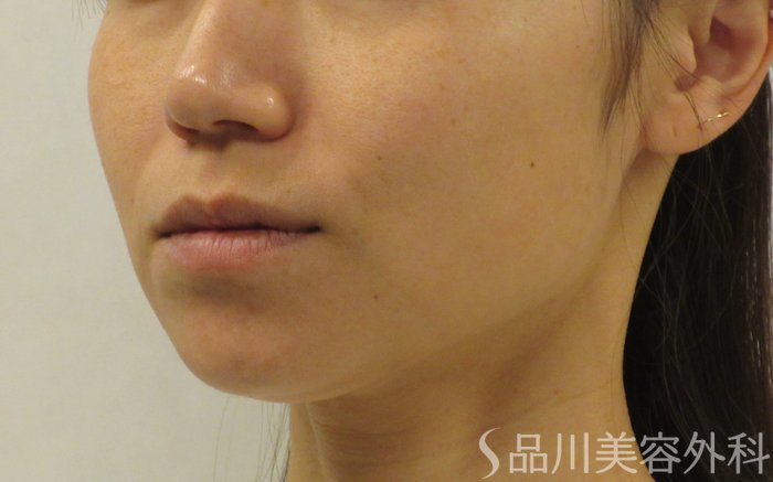 症例NO.70897のBEFORE写真