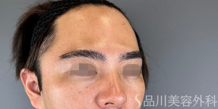 症例NO.69504のBEFORE写真