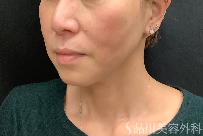 症例NO.71293のAFTER写真