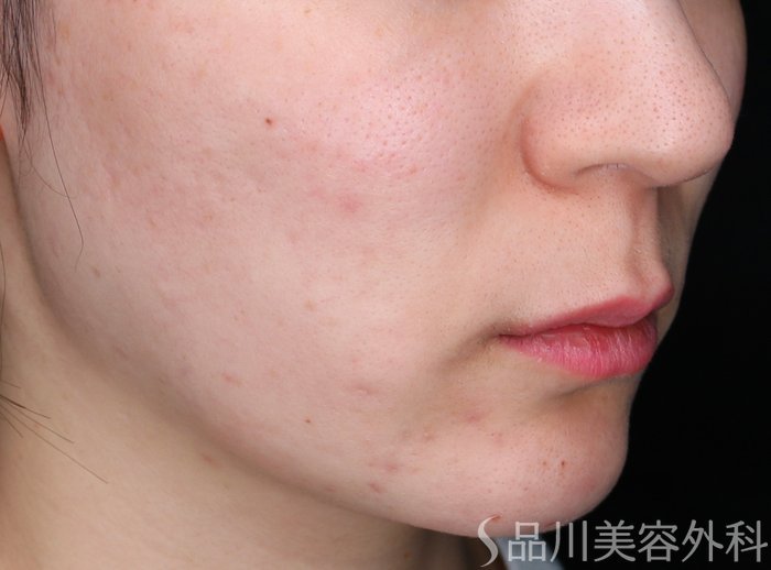 症例NO.69330のBEFORE写真