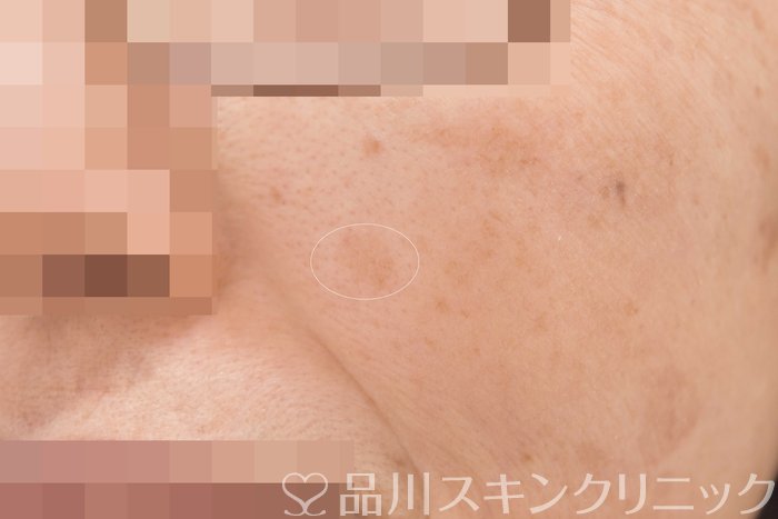 症例NO.64778のBEFORE写真